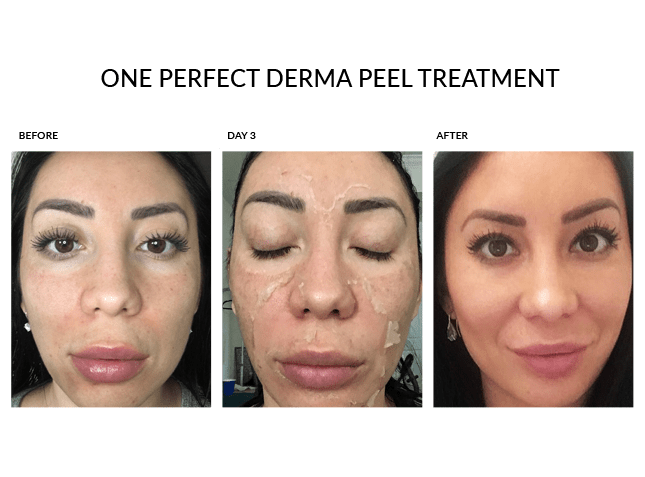 Before and after pics of Derma Peel Treatment at Vbeauty Spa in Toronto
