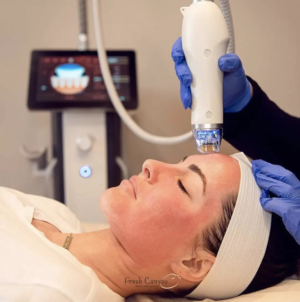 Secret™ RF Microneedling Procedure at Fresh Canvas Spa and Laser Centre in Surrey, BC