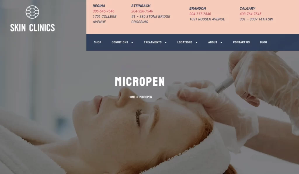 Overview of Micropen Microneedling procedure at SKIN Clinics - Regina