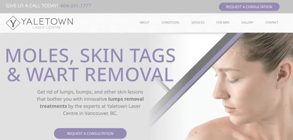 Moles, Skin Tags & Wart Removal Website page screenshot - Yaletown Laser Centre, Vancouver