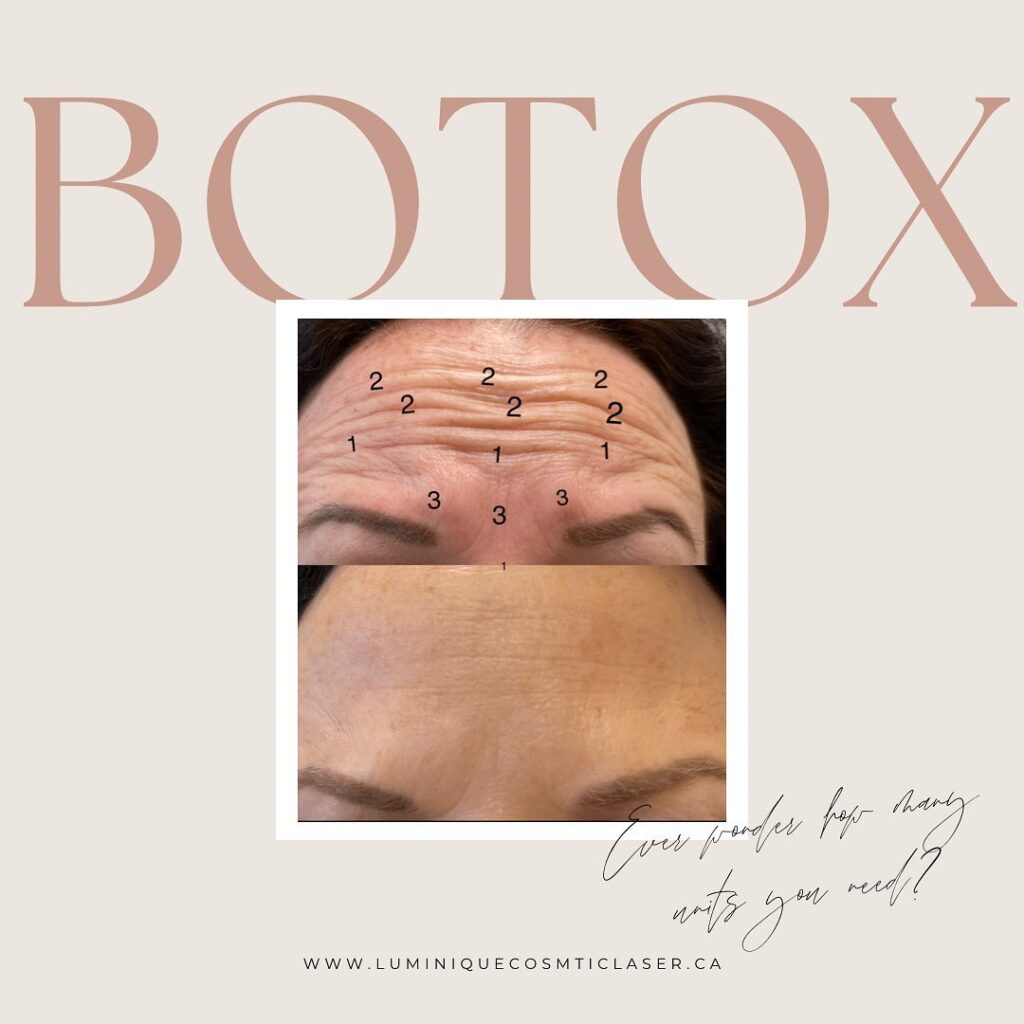 Luminique Cosmetic and Laser Centre's Botox Anti-Wrinkle Treatment
