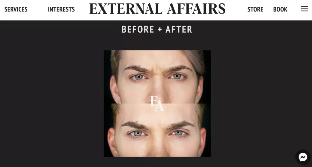 External Affairs Medical Spa's Before and After Photos of Botox Edmonton