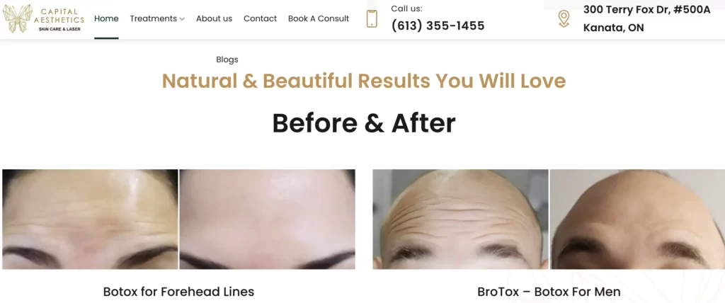 Capital Aesthetics Clinic Botox Before and After Images