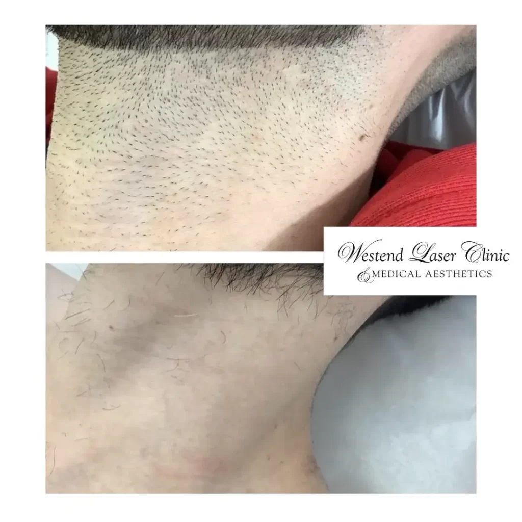Results of Laser hair removal treatments at Westend Laser Clinic & Medical Aesthetics, Ottawa